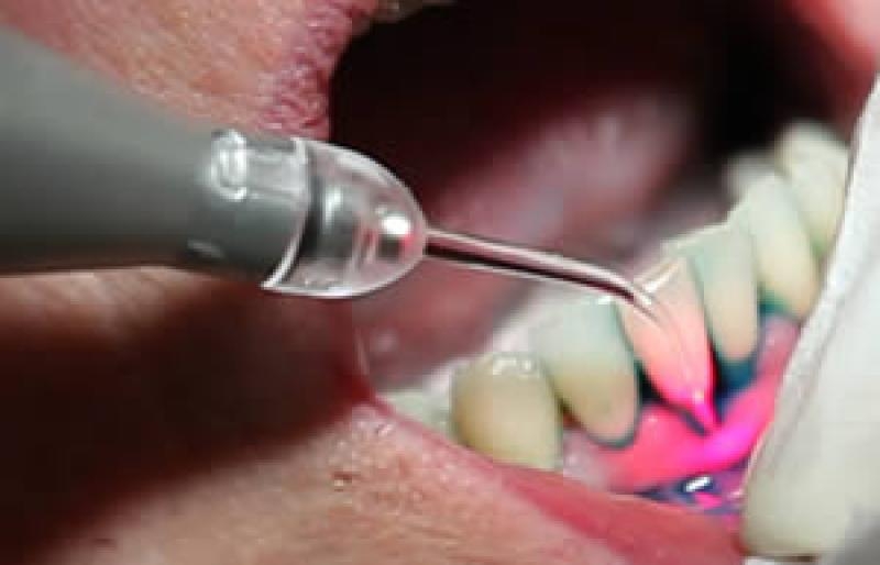 Soft Tissue Laser (Biolase) Highland Dental Centre, Pictou County Dentist