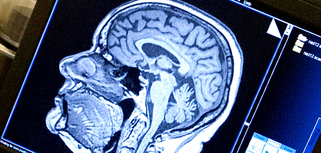 Common brain changes found in children with autism, ADHD and OCD