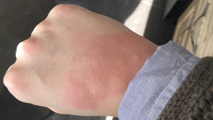Bed Bugs Bites Burning Skin of Students & Firefighters Now Infested Too