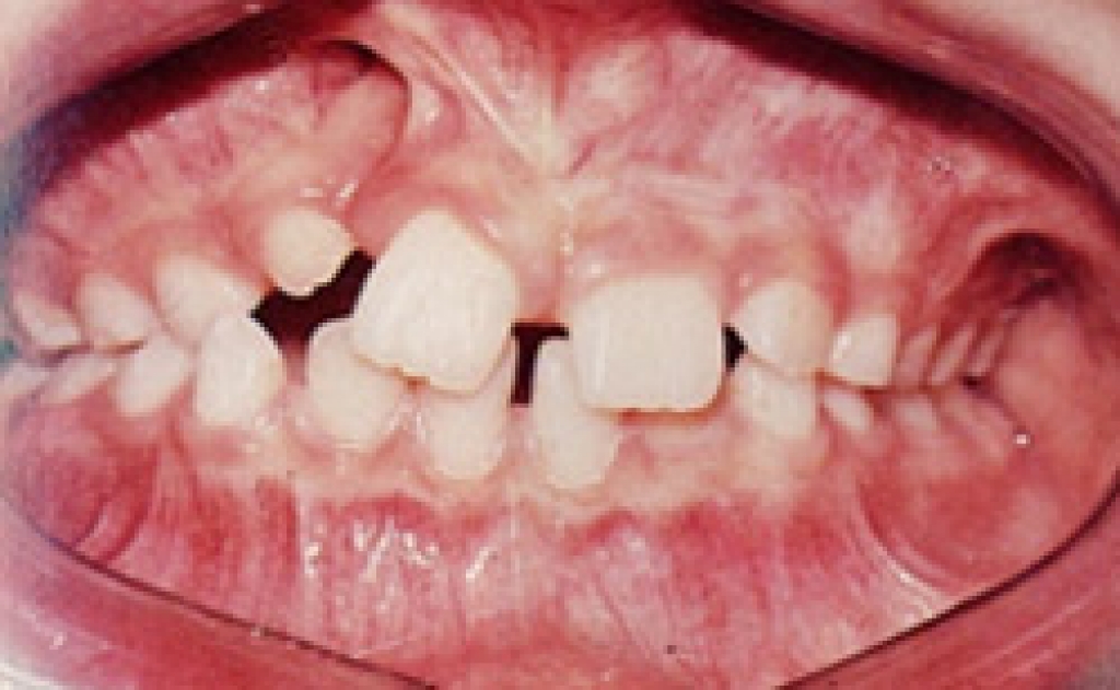 Before & After Ridge Meadows Orthodontics, BC