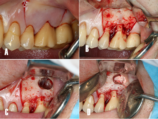 Resolución de sinusitis maxilar odontogénica mediante cirugía periapical