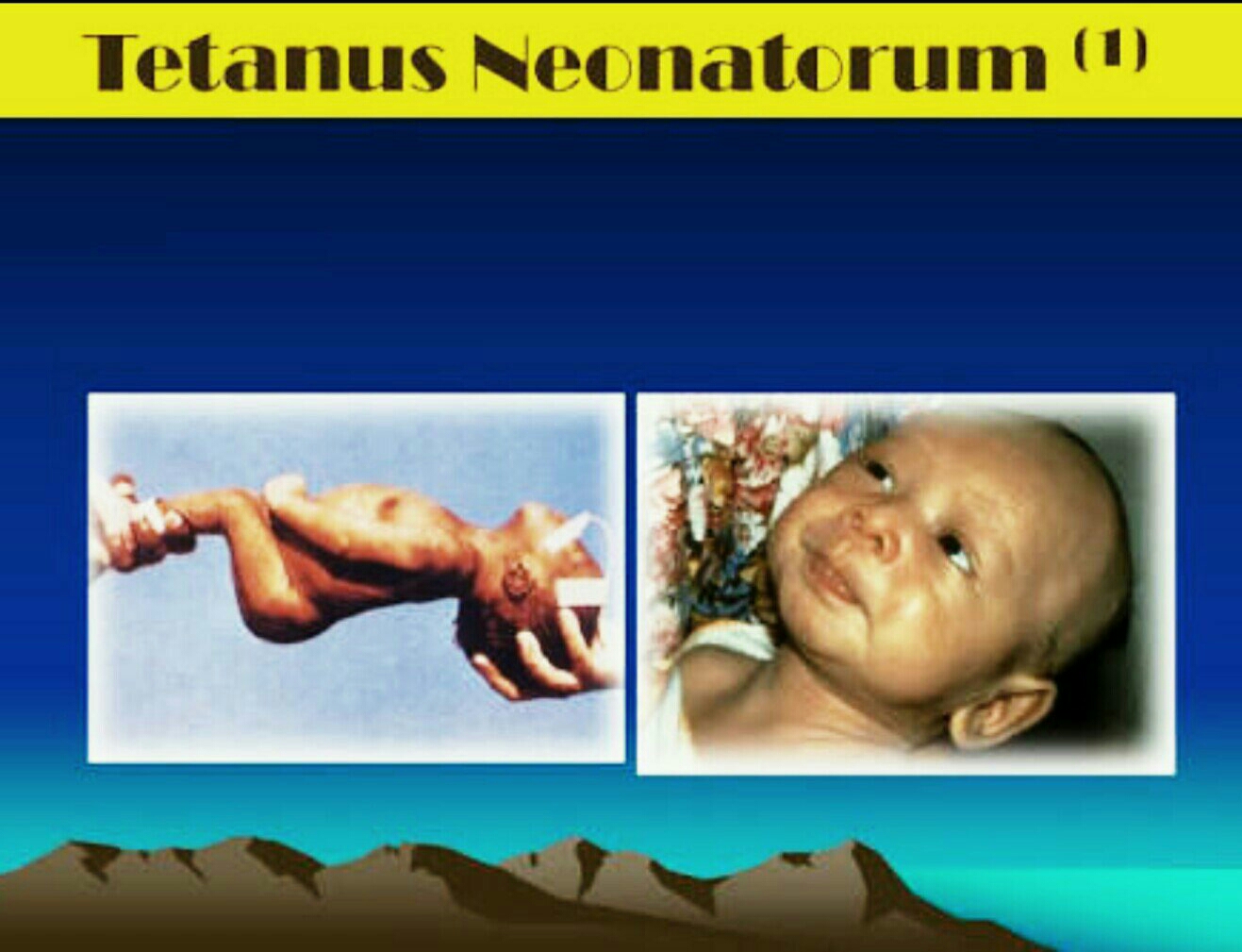 Bahaya Tetanus Neonatorum pada Bayi AtmaGo