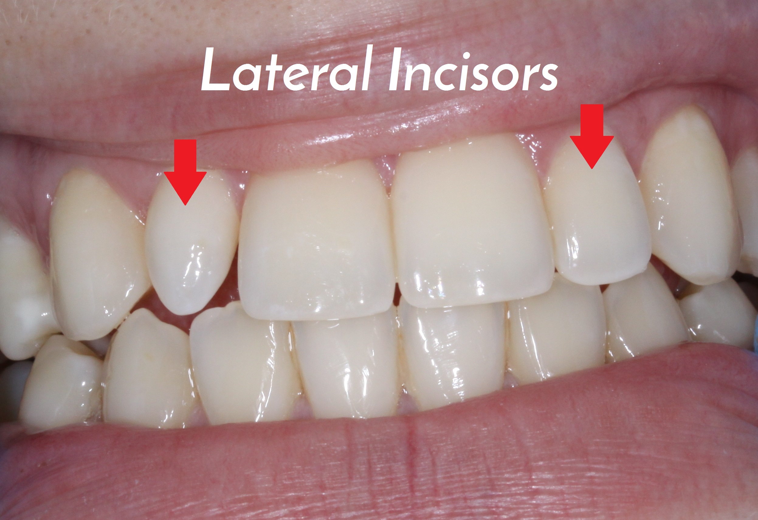 Missing Permanent Teeth The Healthy Mouth Project