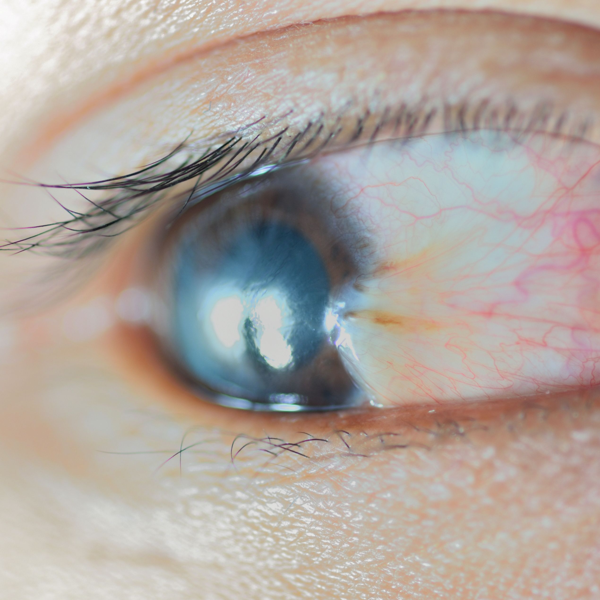 Pterygium Treatment - Merrillville, In - Surfer's Eye