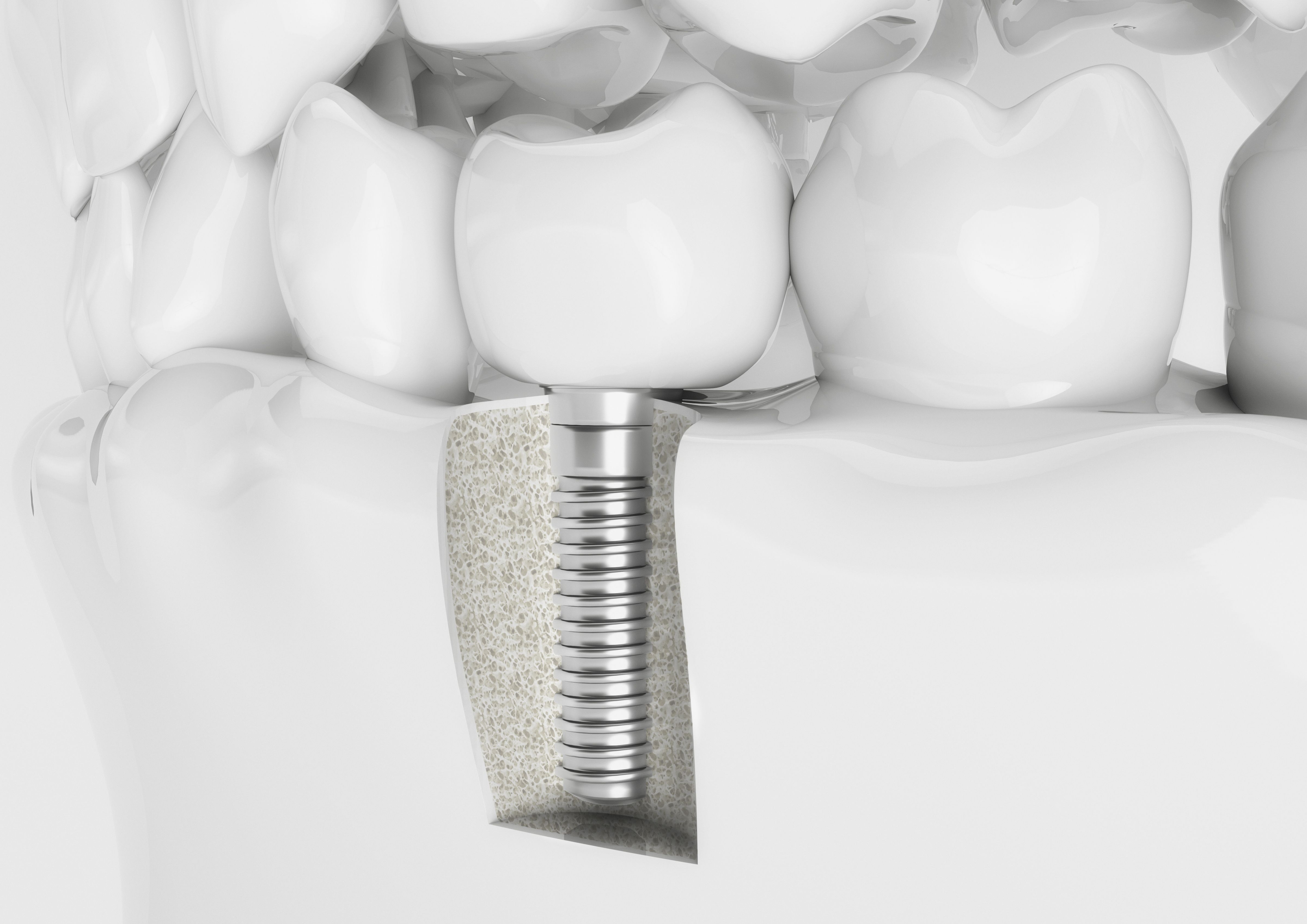 How Dental Implants Prevent Bone Loss Harrisonburg, VA