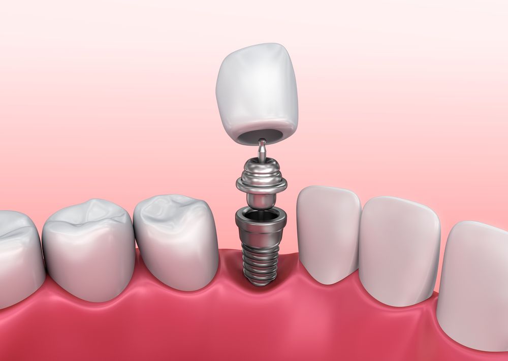 History of Dental Implants Philadelphia, PA Restorative Dentistry