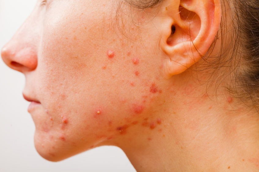 6 Cara Mengatasi Jerawat Di Dagu Karena Masker Womantalk