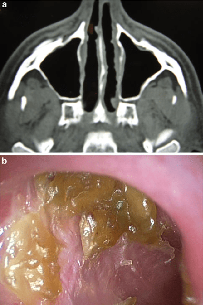 Rhinitis sicca, dry nose and atrophic rhinitis a review of the