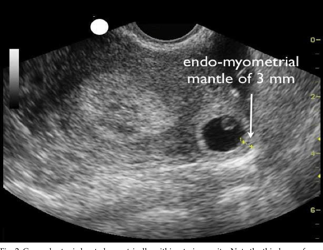 Figure 2 from Modern Management of Cornual Ectopic Pregnancy Semantic