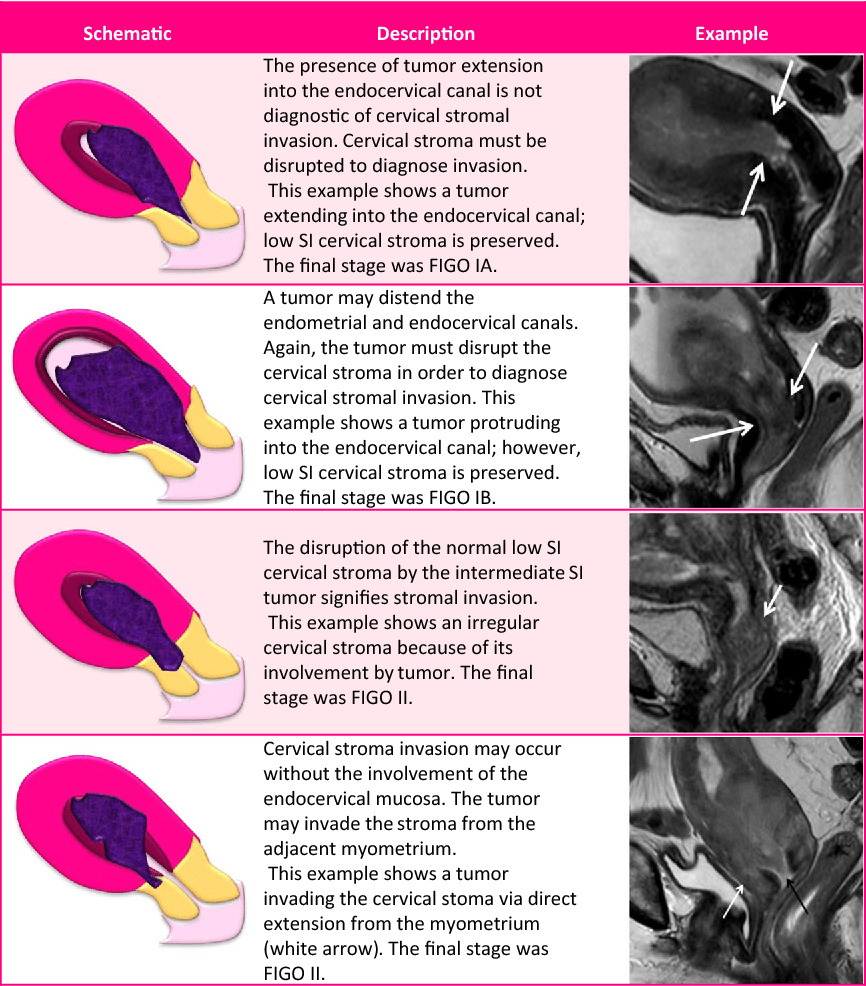 Endometrial Cancer MRI staging Updated Guidelines of the European