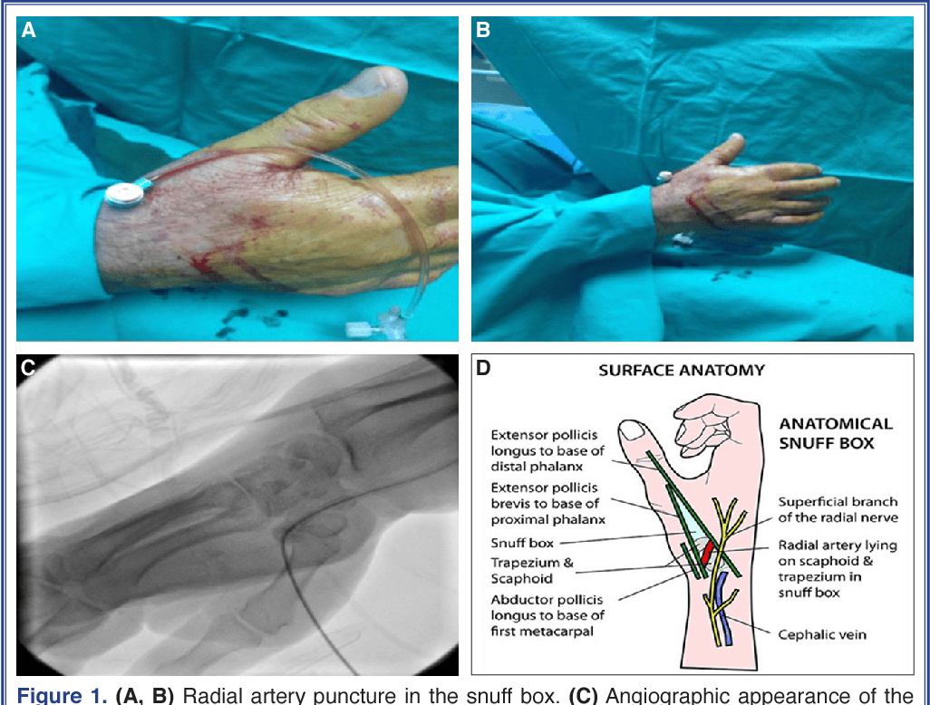 Pdf] Safe Entry Site For Coronary Angiography: Snuff Box. | Semantic Scholar
