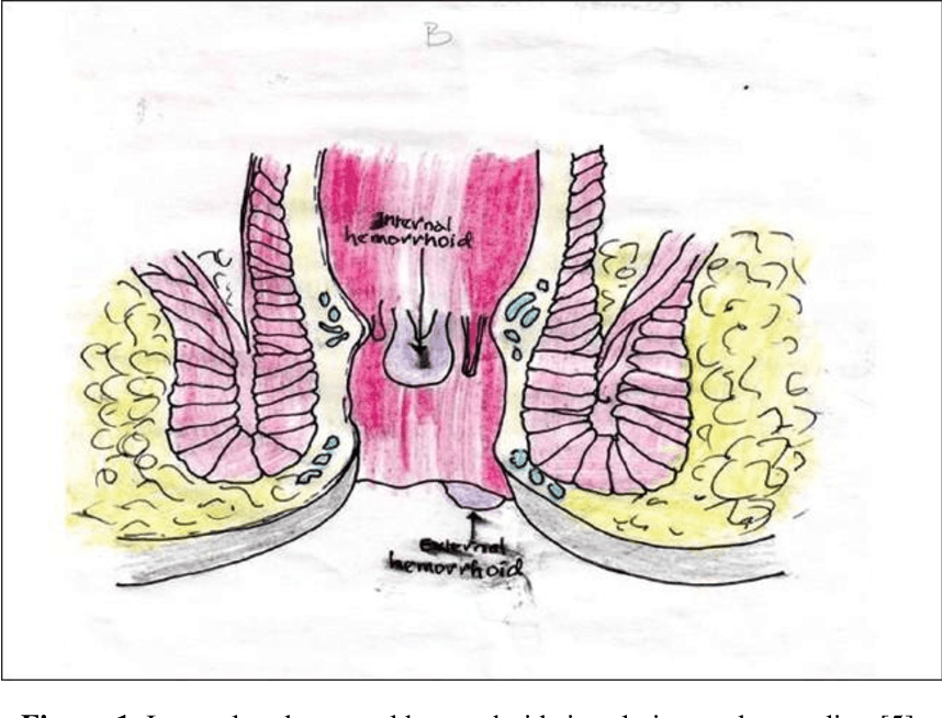 [PDF] SURGICAL OPTIONS AND INDICATION OF HEMORRHOIDECTOMY Semantic