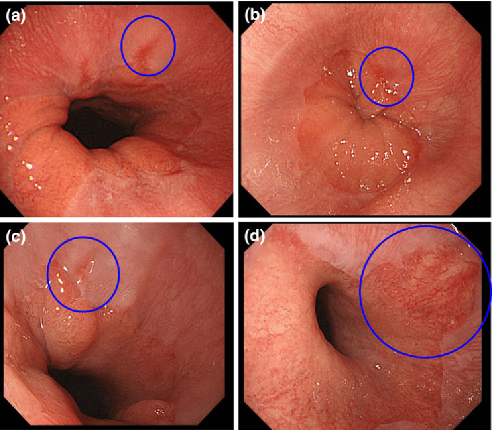 Erosive Esophagitis Diet 48 Wedding Decorations Ideas & Simple