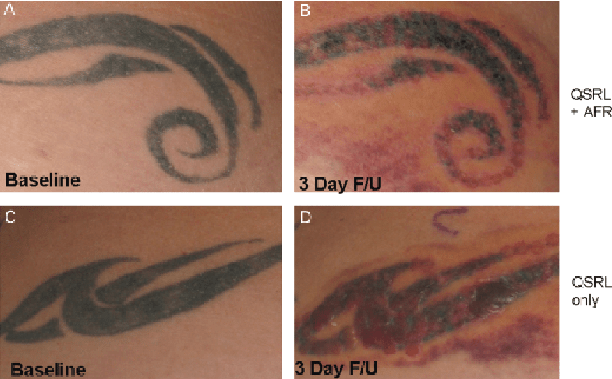 Figure 2 From Combining Fractional Resurfacing And Q‐Switched Ruby Laser For Tattoo Removal | Semantic Scholar 536_x_866_png