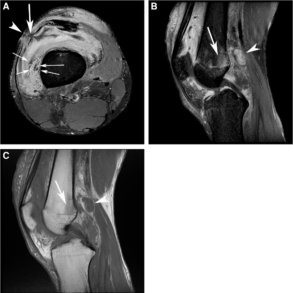Synovitis of the knee following a highpressure injection injury with