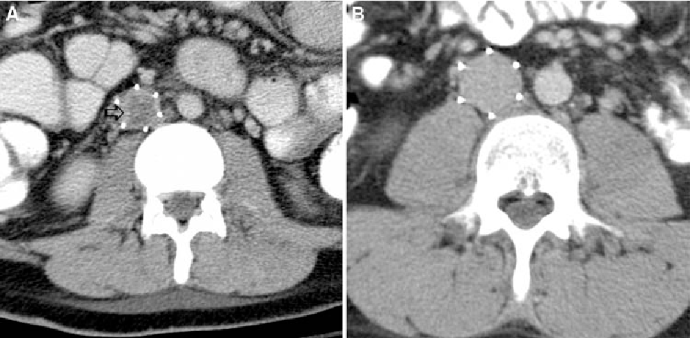 Clinical Sequelae of Thrombus in an Inferior Vena Cava Filter