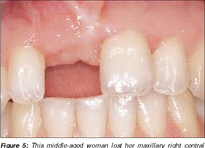 [PDF] Singletooth replacement bridge vs. implantsupported