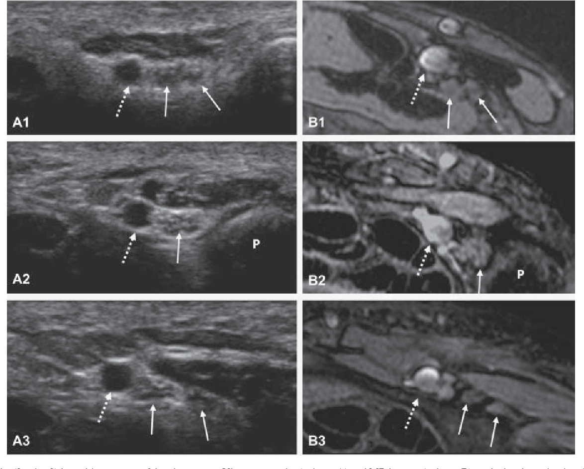 Variations of the ulnar nerve in guyon's canal in vivo demonstration