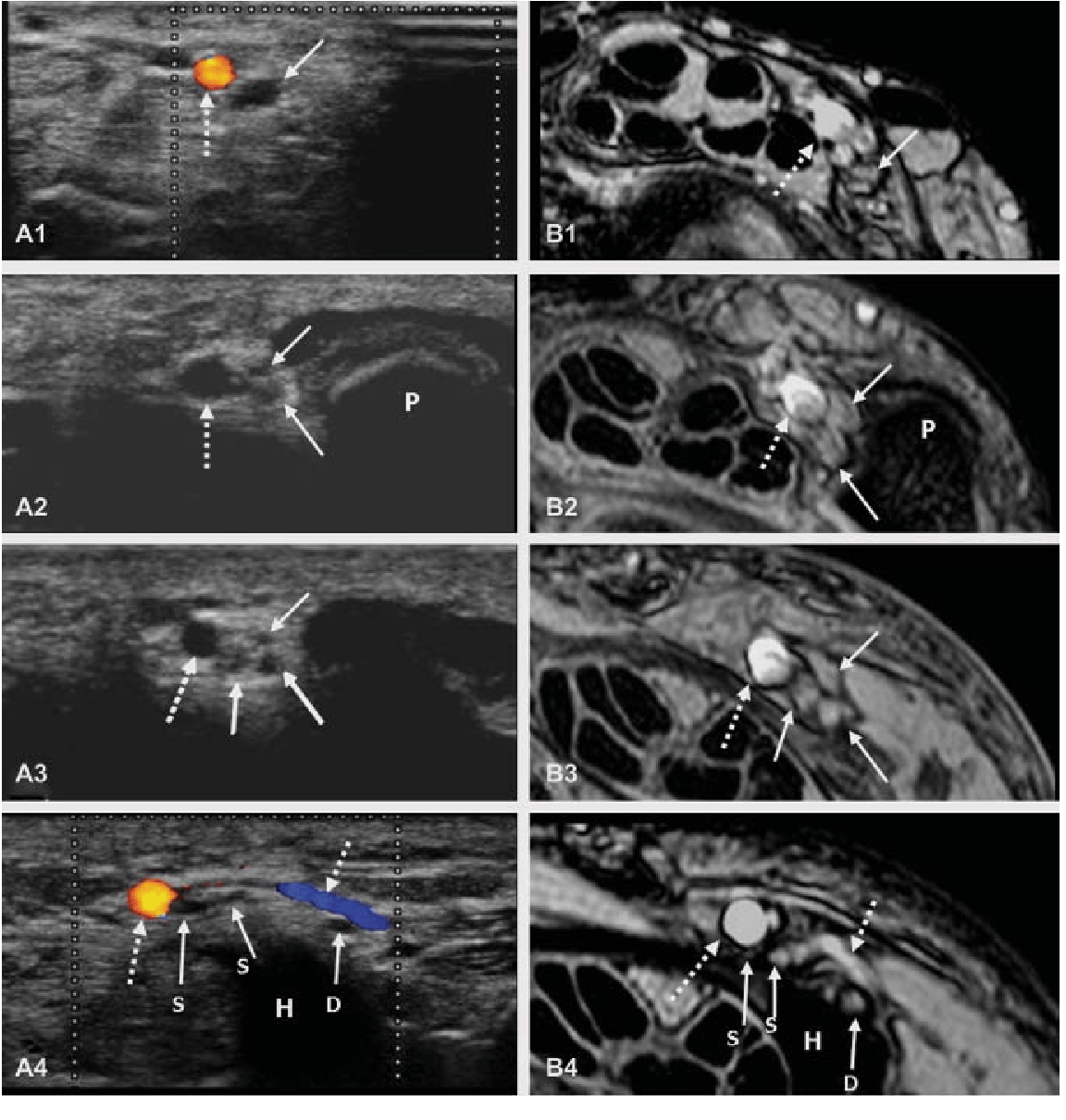 Variations of the ulnar nerve in guyon's canal in vivo demonstration