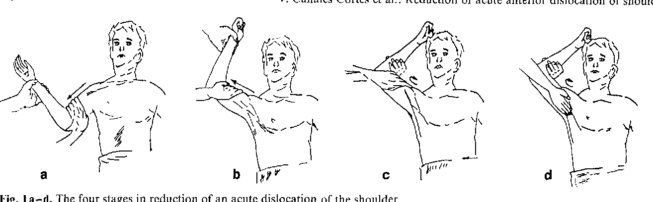 Figure 1 from Reduction of acute anterior dislocations of the shoulder