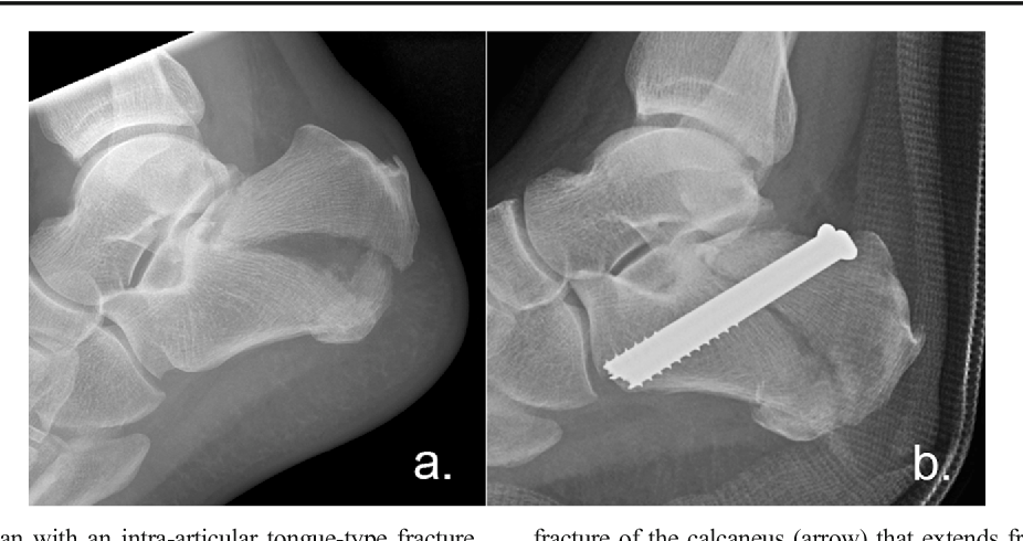 Figure 5 from Intraarticular tonguetype fractures of the calcaneus