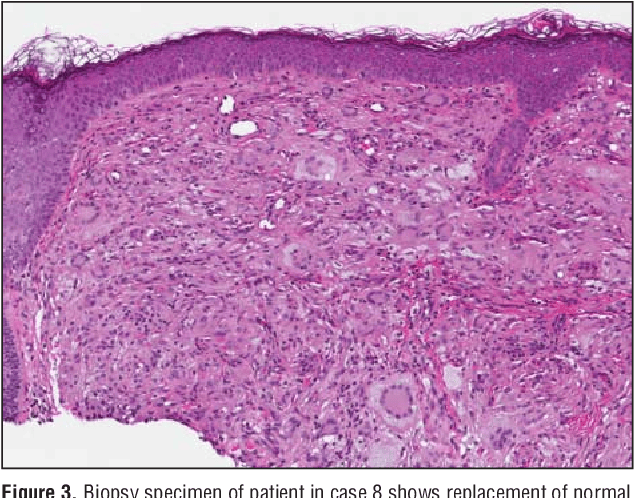 Pdf Xanthoma Disseminatum Effective Therapy With 2 Chlorodeoxyadenosine In A Case Series Semantic Scholar