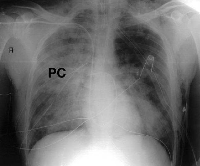 Pulmonary Contusion An Update on Recent Advances in Clinical