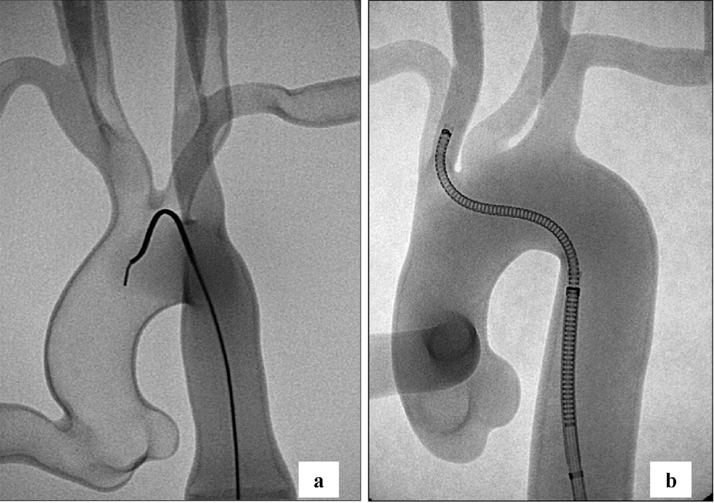 Evaluation of robotic endovascular catheters for arch vessel