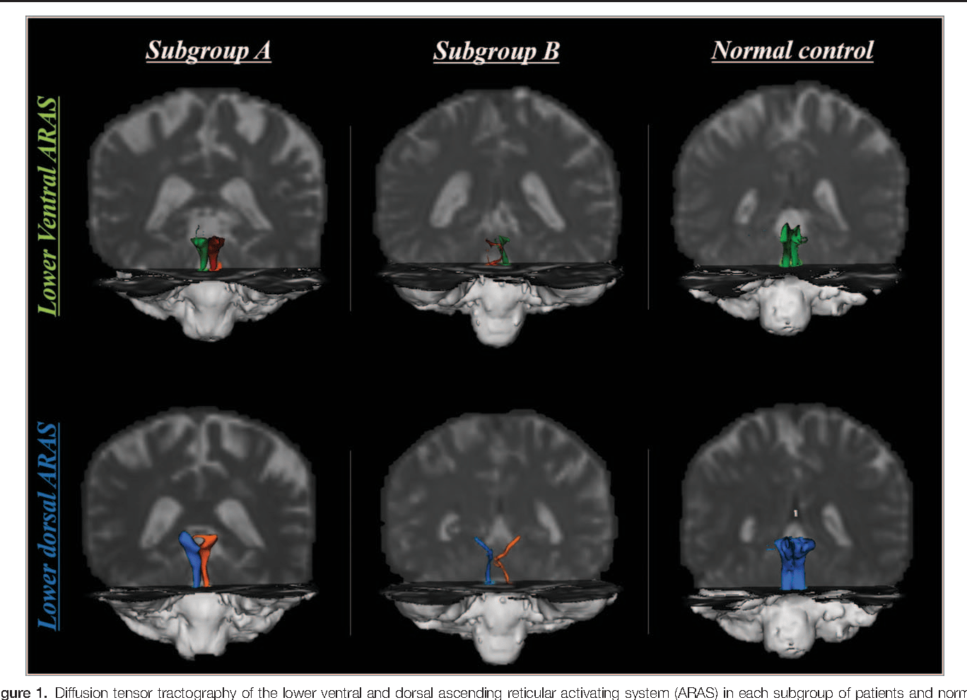Injury of the lower ascending reticular activating system in patients