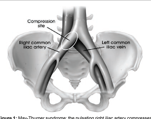 Left Common Iliac Vein Compression Syndrome ovulation symptoms