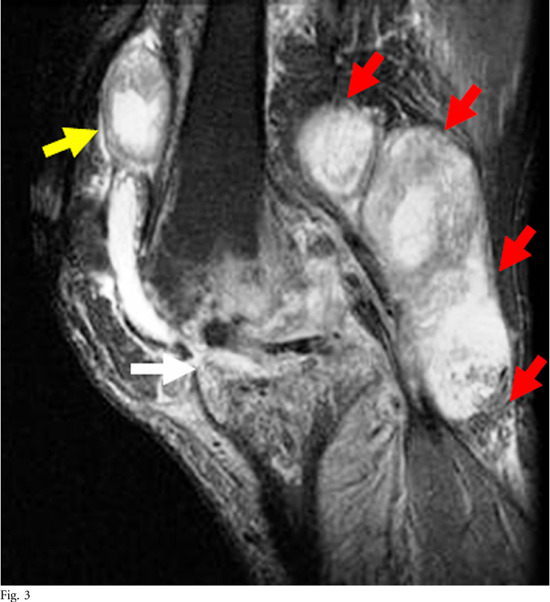 Tuberculous arthritis of the knee treated with twostage total knee