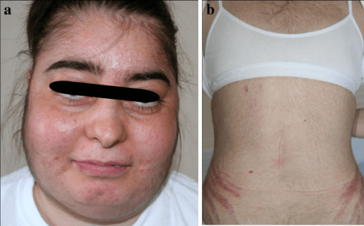 CushingSyndrom & Hyperkortisolismus Diagnose undTherapie