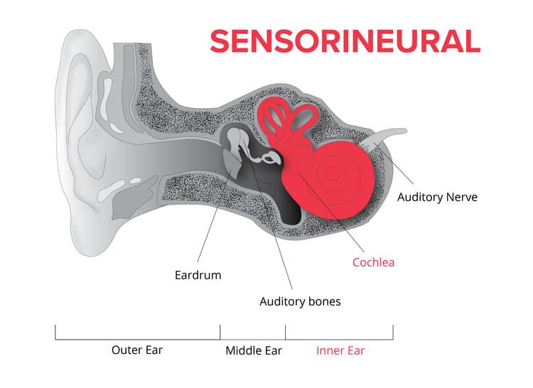 Types of Hearing Loss & Degrees of Hearing Loss Speech & Hearing