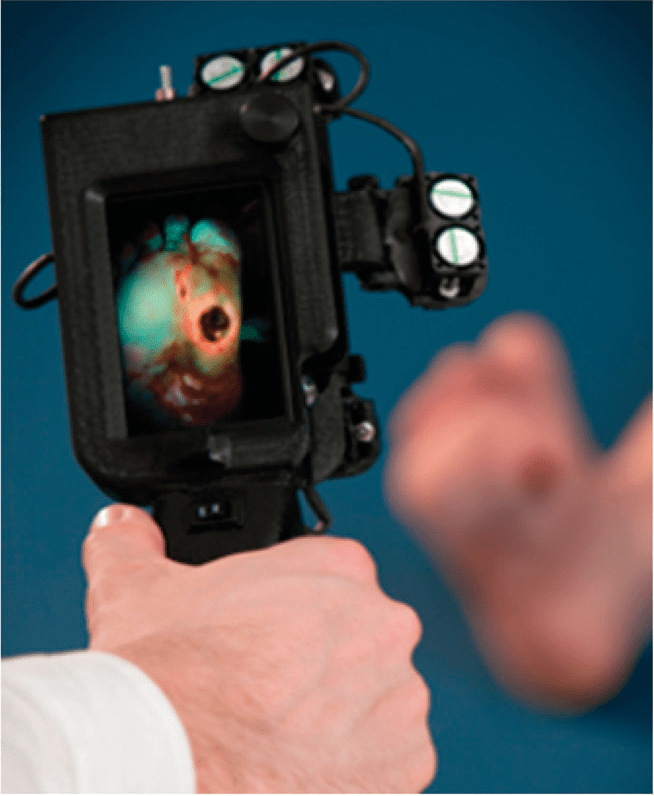 Handheld Fluorescence Imaging Device Detects Subclinical Wound