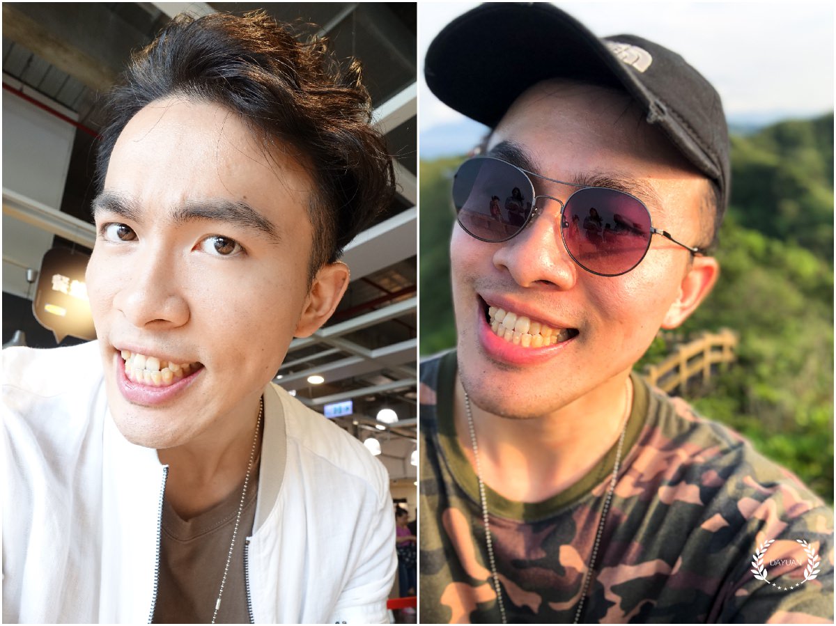 牙齒矯正｜SOV舒服美 關於隱形牙套，你可能想知道的事（5）