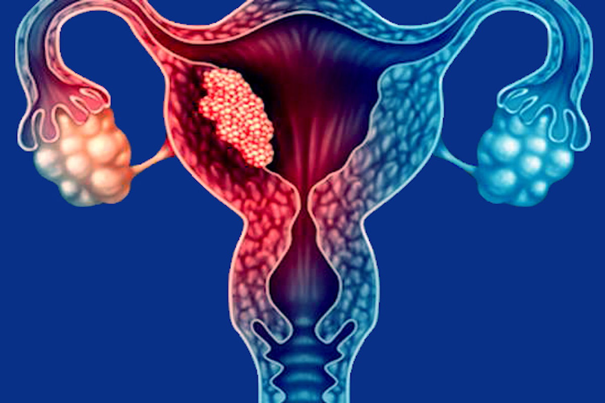 Uterine (Endometrial) Cancer Types, Risk Factors, Symptoms & Treatment