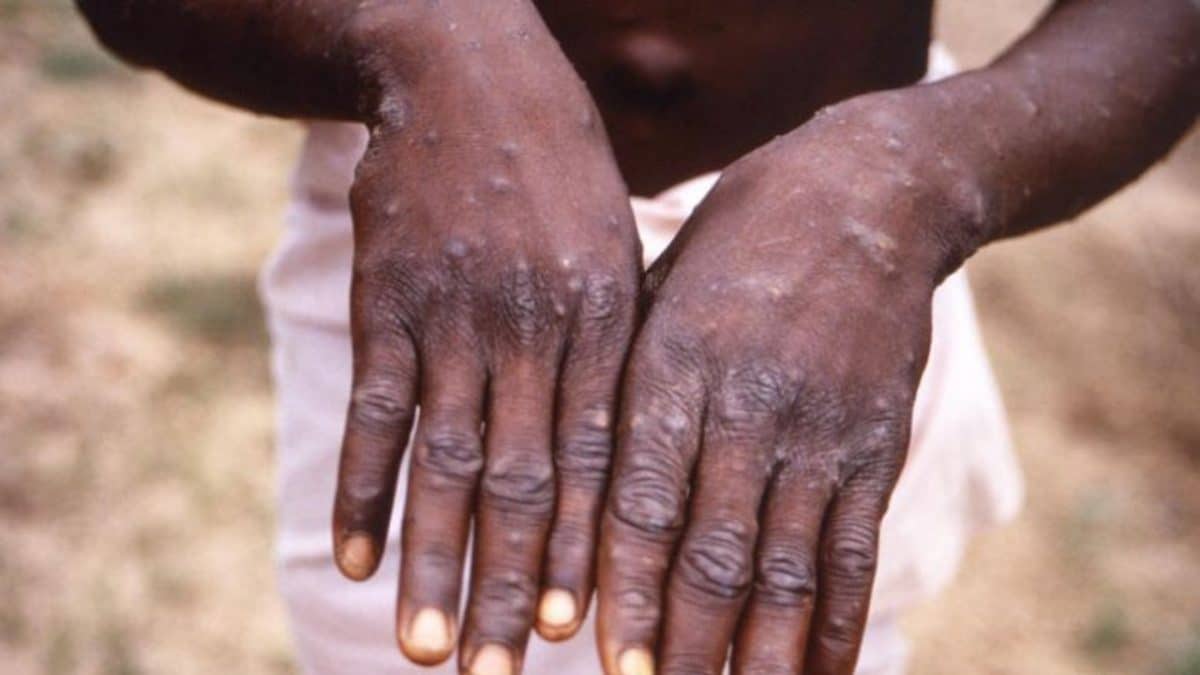 Monkeypox 12 things you must know about deadly disease Daily Post