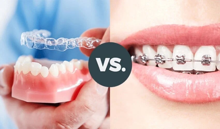 Braces vs. Aligners Choosing the Right Orthodontic Treatment for Your