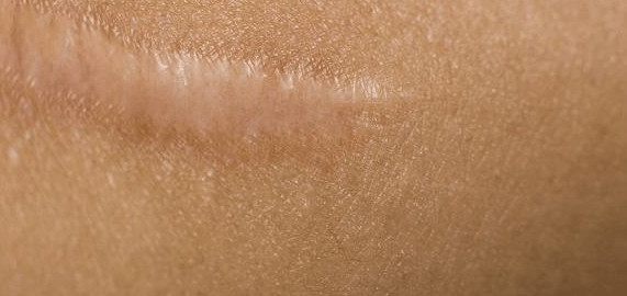 Apa Itu Keloid dan Bagaimana Cara Mengatasinya