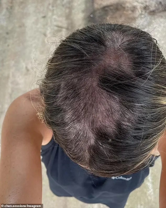 El Cabello Comenzó A Caerse Después De Que Dejó De Tomar Píldoras