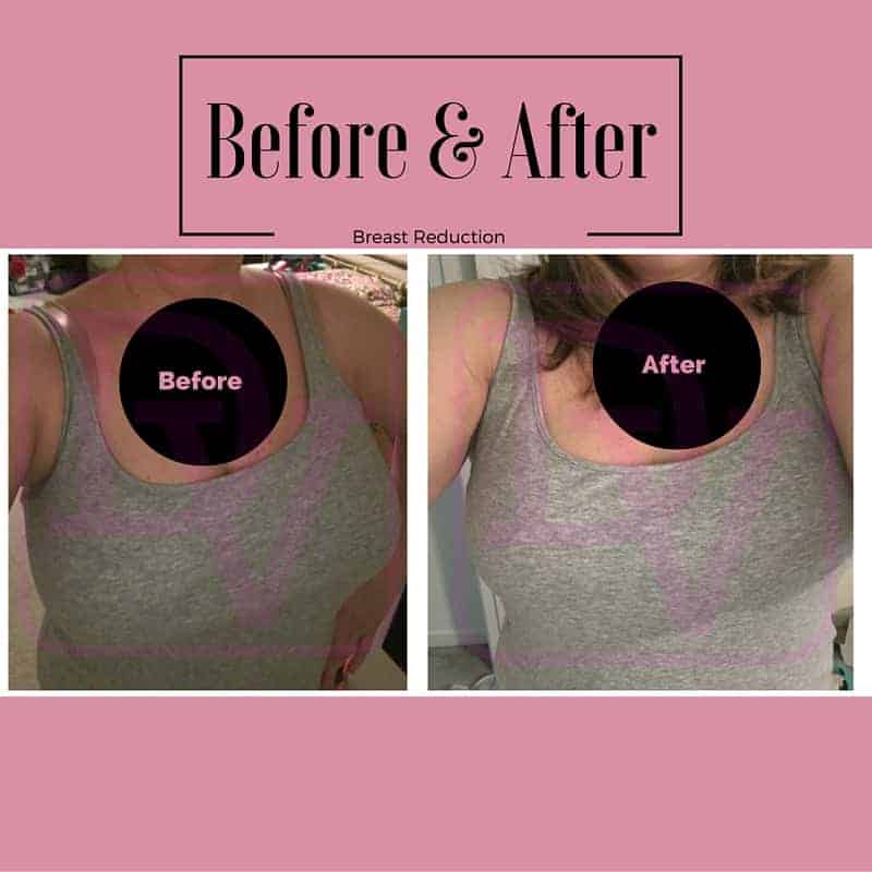 1 Simple True Story How A Breast Reduction Changed My Life