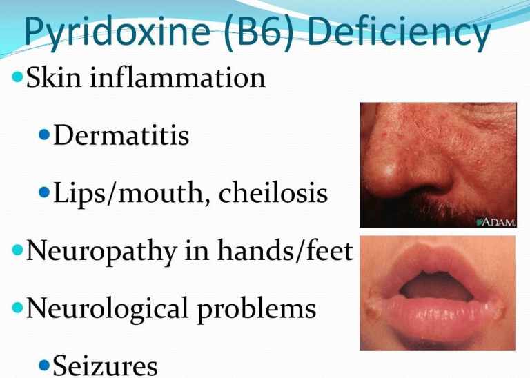 Deficiency of Vitamin B6 (Pyridoxine) daneelyunus