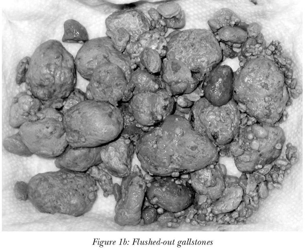 Detoxifying your liver Daniel Mitel