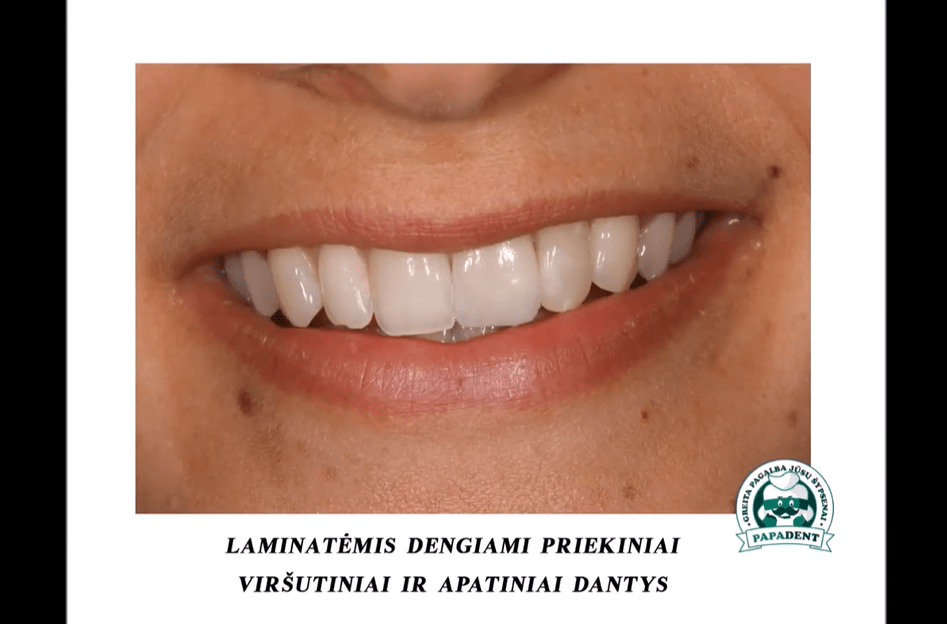 Dantų laminatės Dažniausiai užduodami klausimai (Video lietuvių k