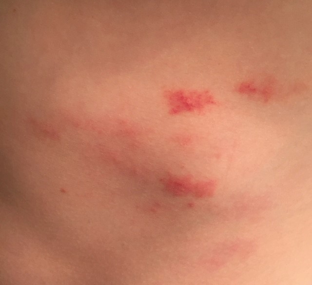 Oak mites cause break outs of itchy bites