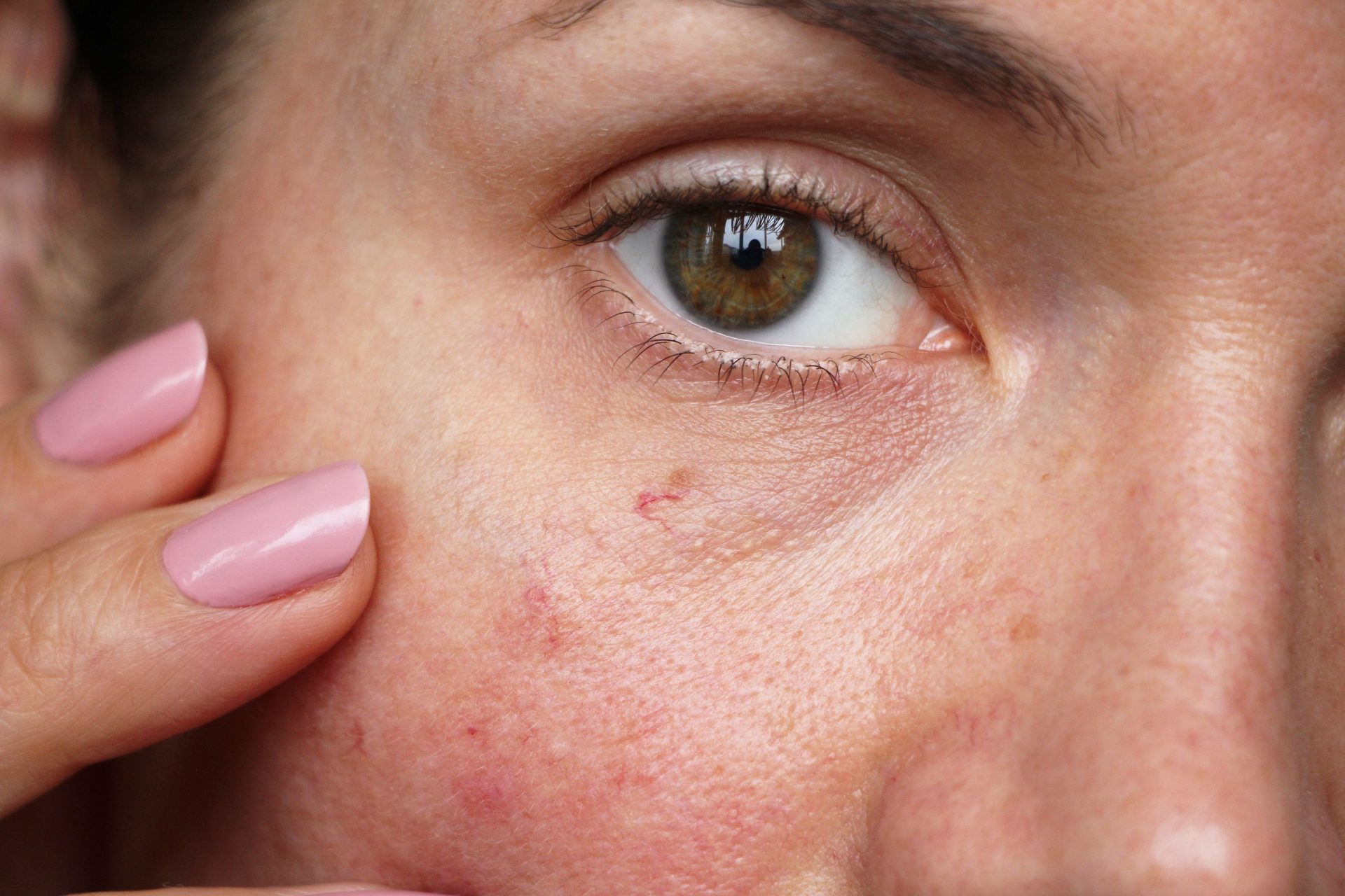 Red Vein Removal Darwin Aesthetics