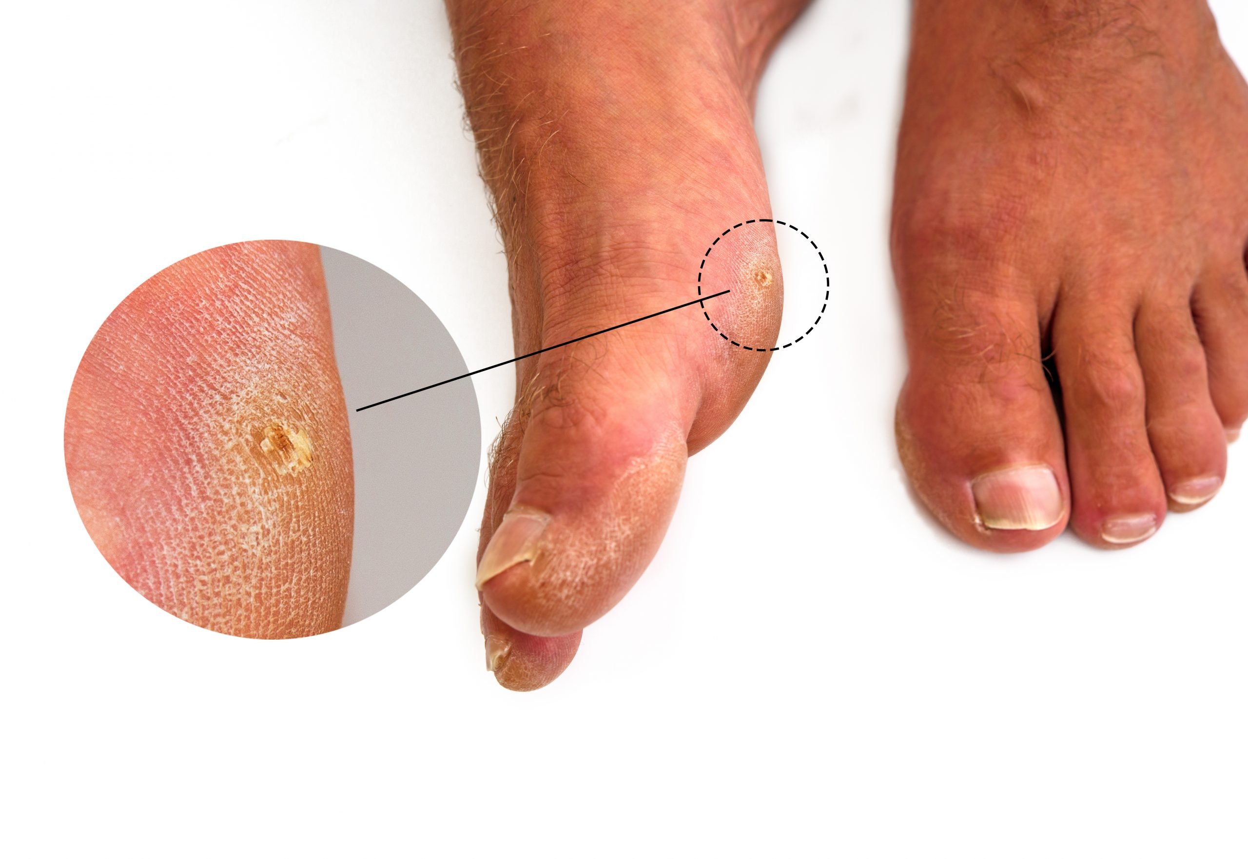 Corn vs. Callus vs. Wart Darwin Podiatry