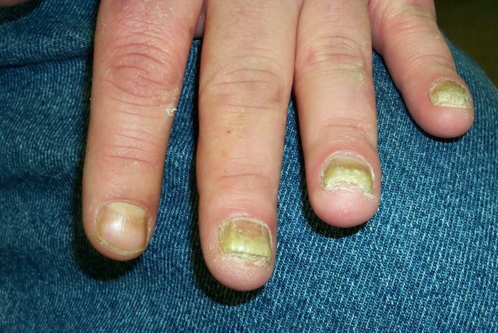 Fingernail infections Types, Causes, Symptoms, Diagnosis, and Treatment