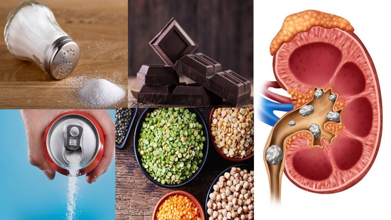 The Link Between Beer And Kidney Stones AC/DC Beverage