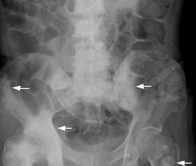 Stunning Kanser Tulang Awe-Inspiring